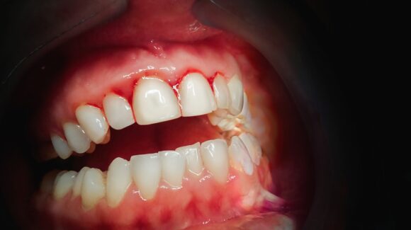 7 things to know about periodontal/gum care