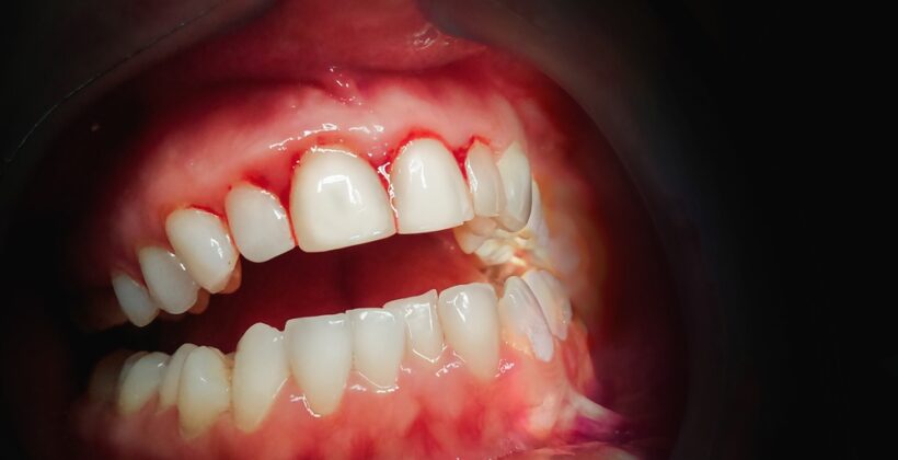 7 things to know about periodontal/gum care