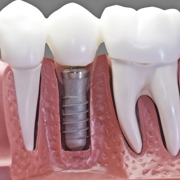 Everything you need to know about dental implants