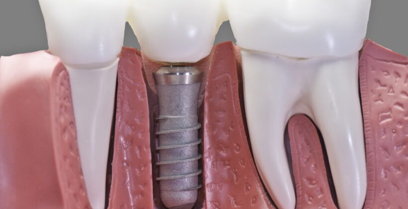 Everything you need to know about dental implants