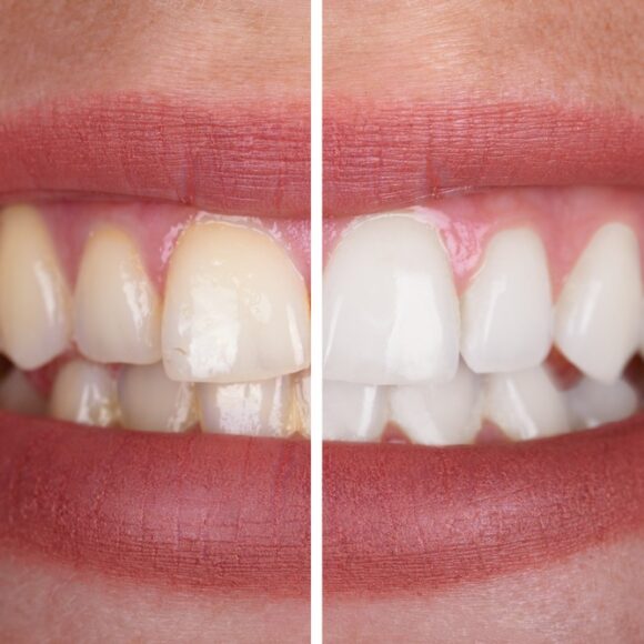 What are the different types of tooth whitening techniques?