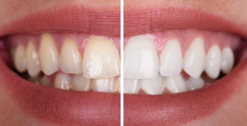 What are the different types of tooth whitening techniques?