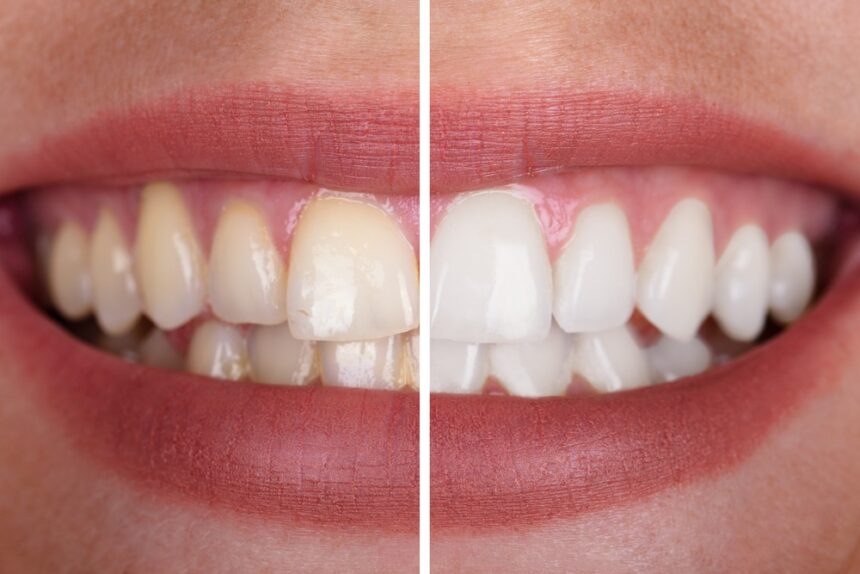 What are the different types of tooth whitening techniques?